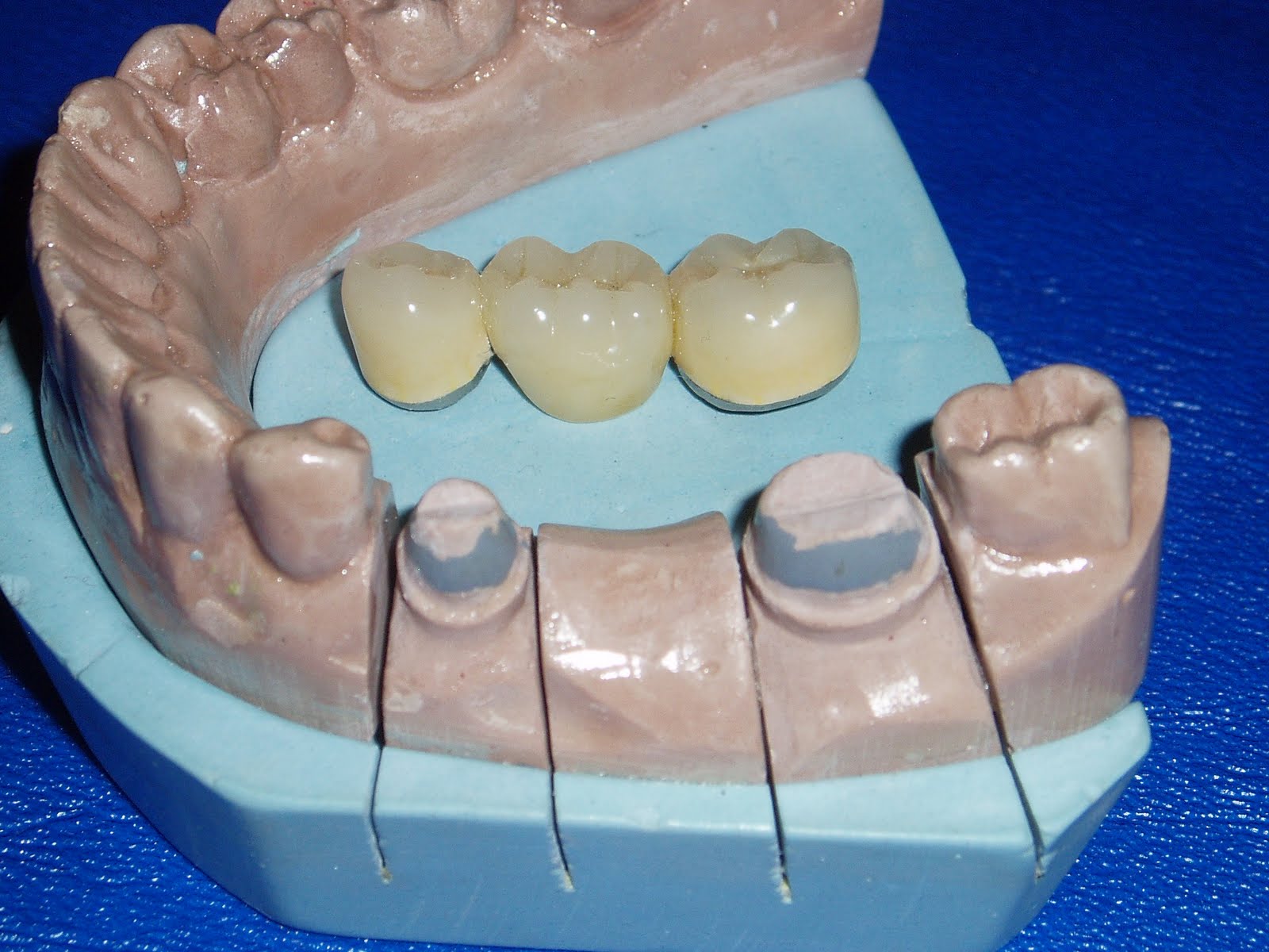 MEGADENT DE PROTESIS DENTAL PORCELANA